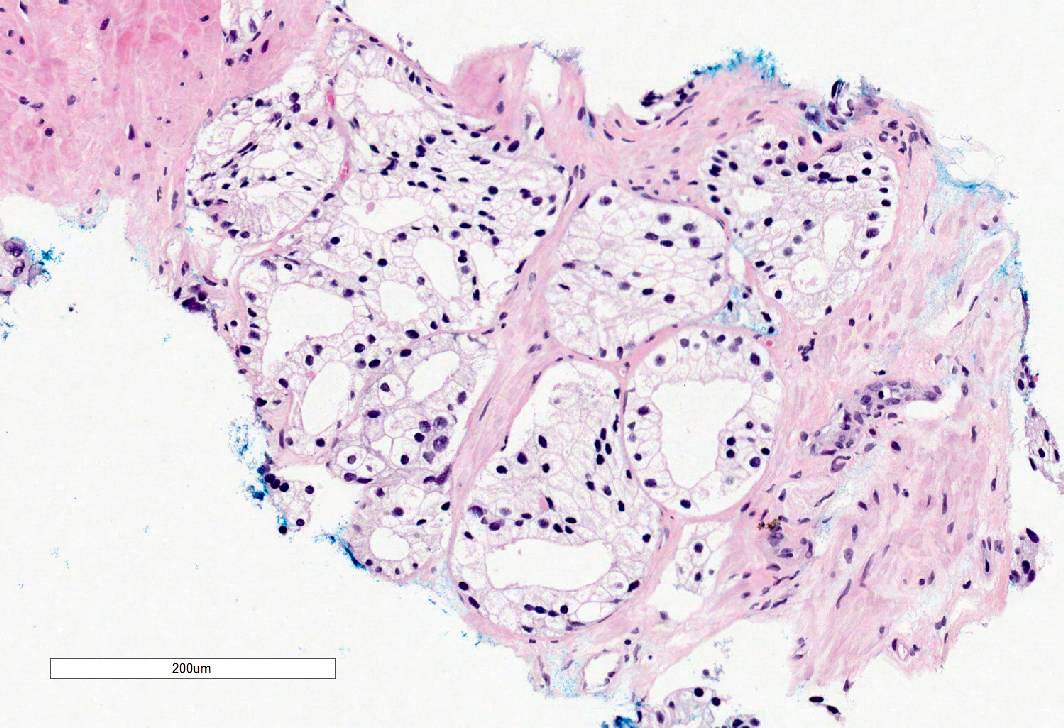 prostate pathology outlines