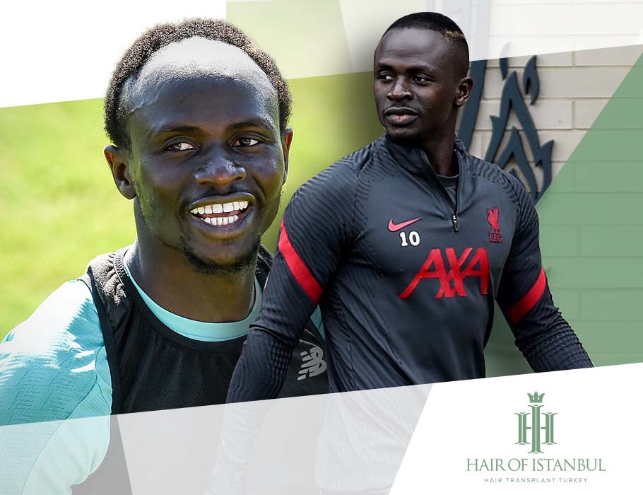 sadio mane hairline