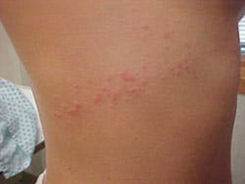 sea lice rash pics