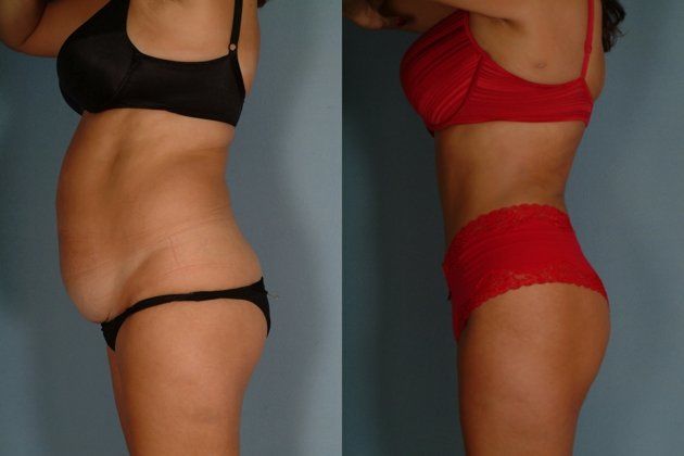 tummy tuck arkansas