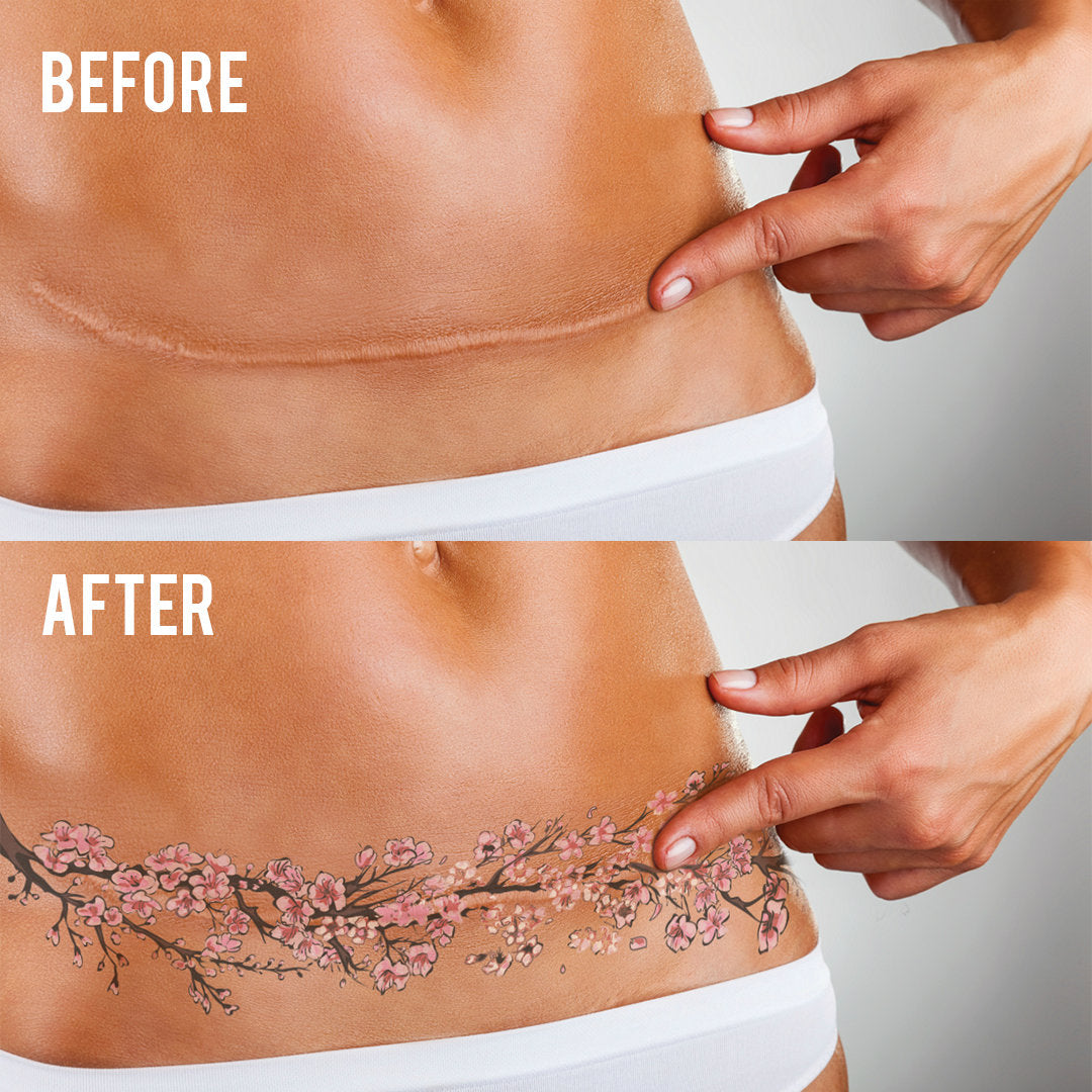 tummy tuck tattoo